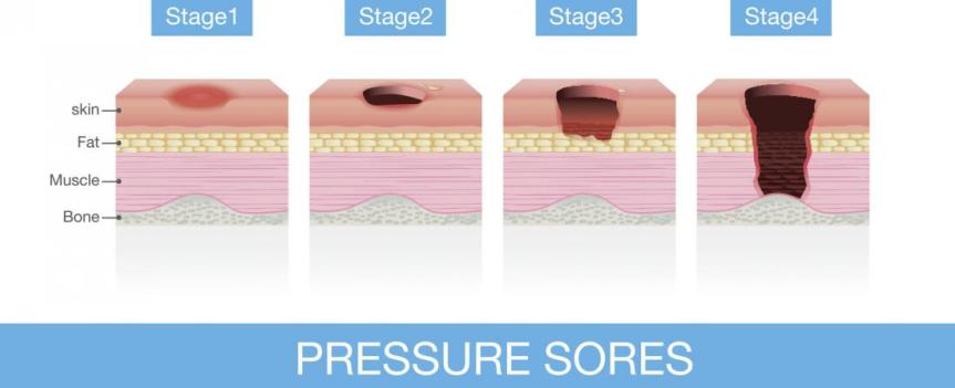 pressure-sores